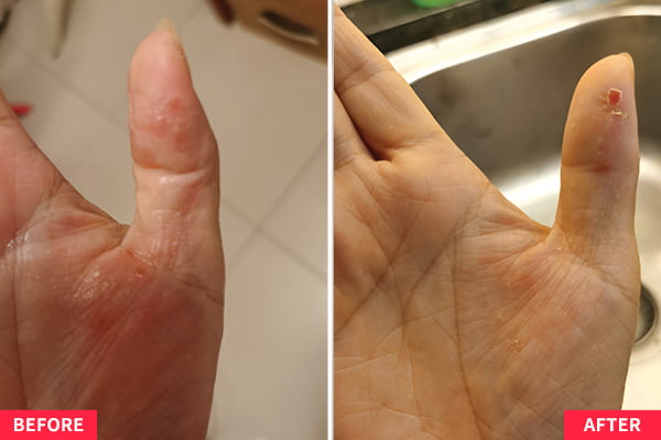 Skin Allergy