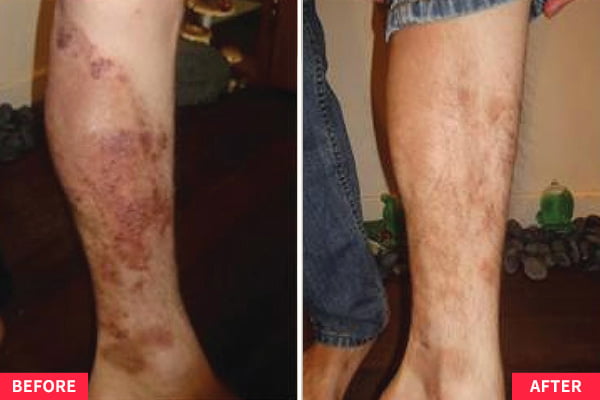 Skin Allergy